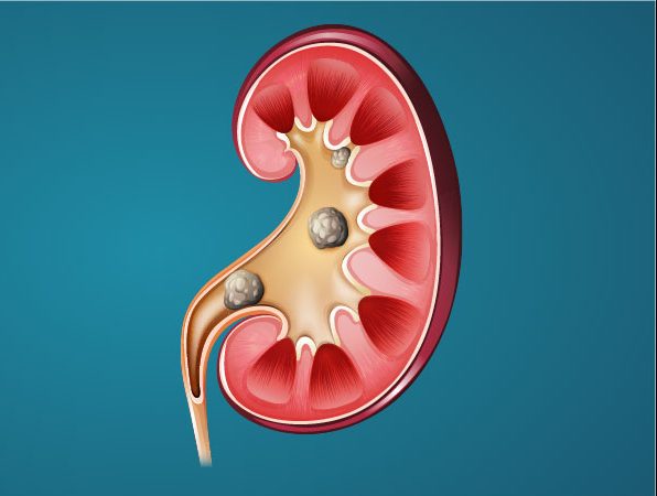 Kidney with kidney stones